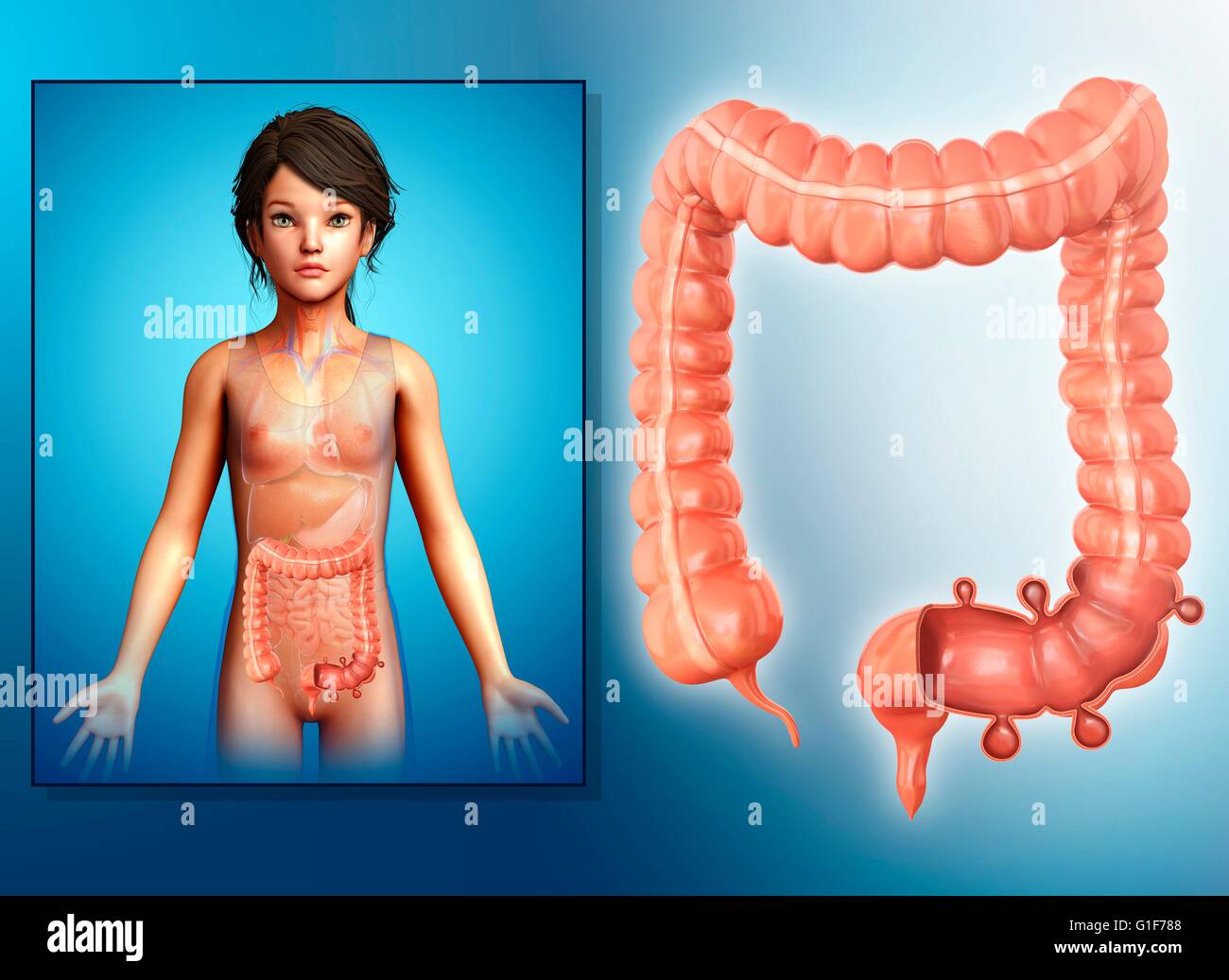 Diverticulosis Of The Human Colon Illustration Stock Photo Alamy