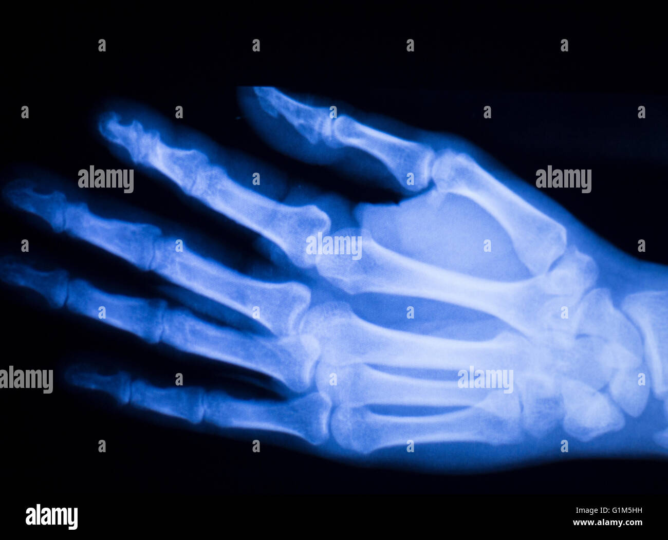 Hand and finger injury medical xray test scan result for adult patient
