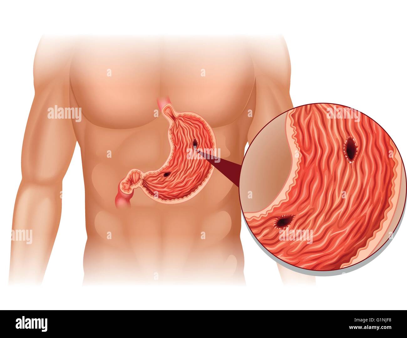 Stomach Ulcer in human body illustration Stock Vector