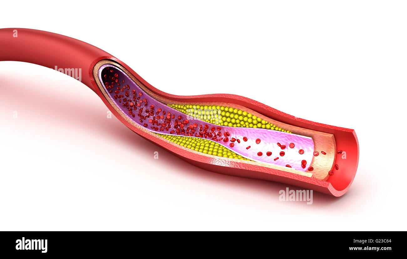 Cholesterol plaque in blood vessel Stock Photo Alamy