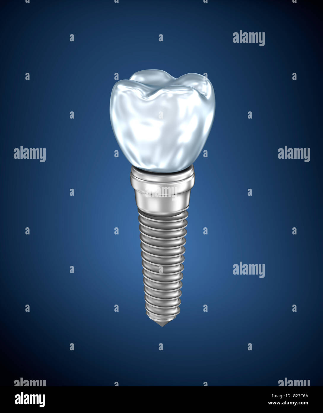 Dental titanium implant Stock Photo Alamy