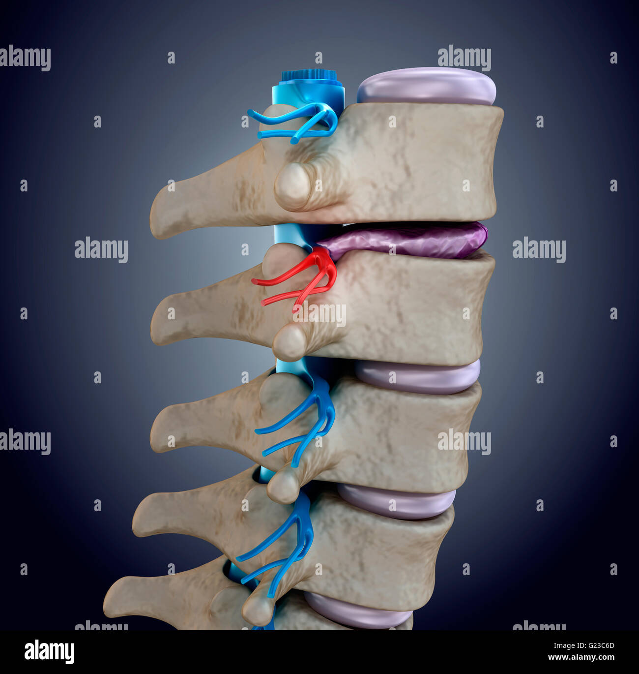 Spinal cord under pressure of bulging disc Stock Photo Alamy