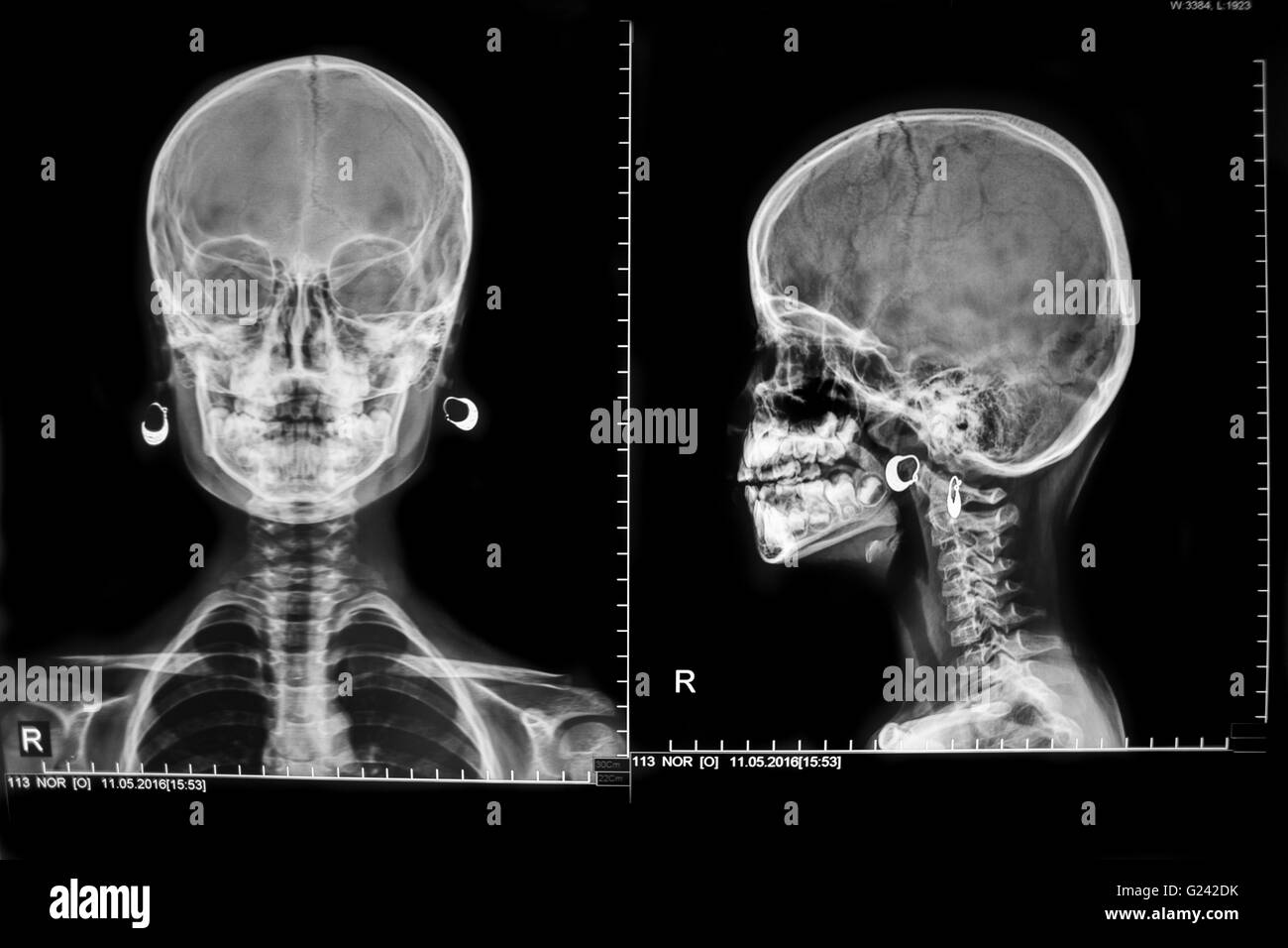 X ray of human skull hires stock photography and images Alamy