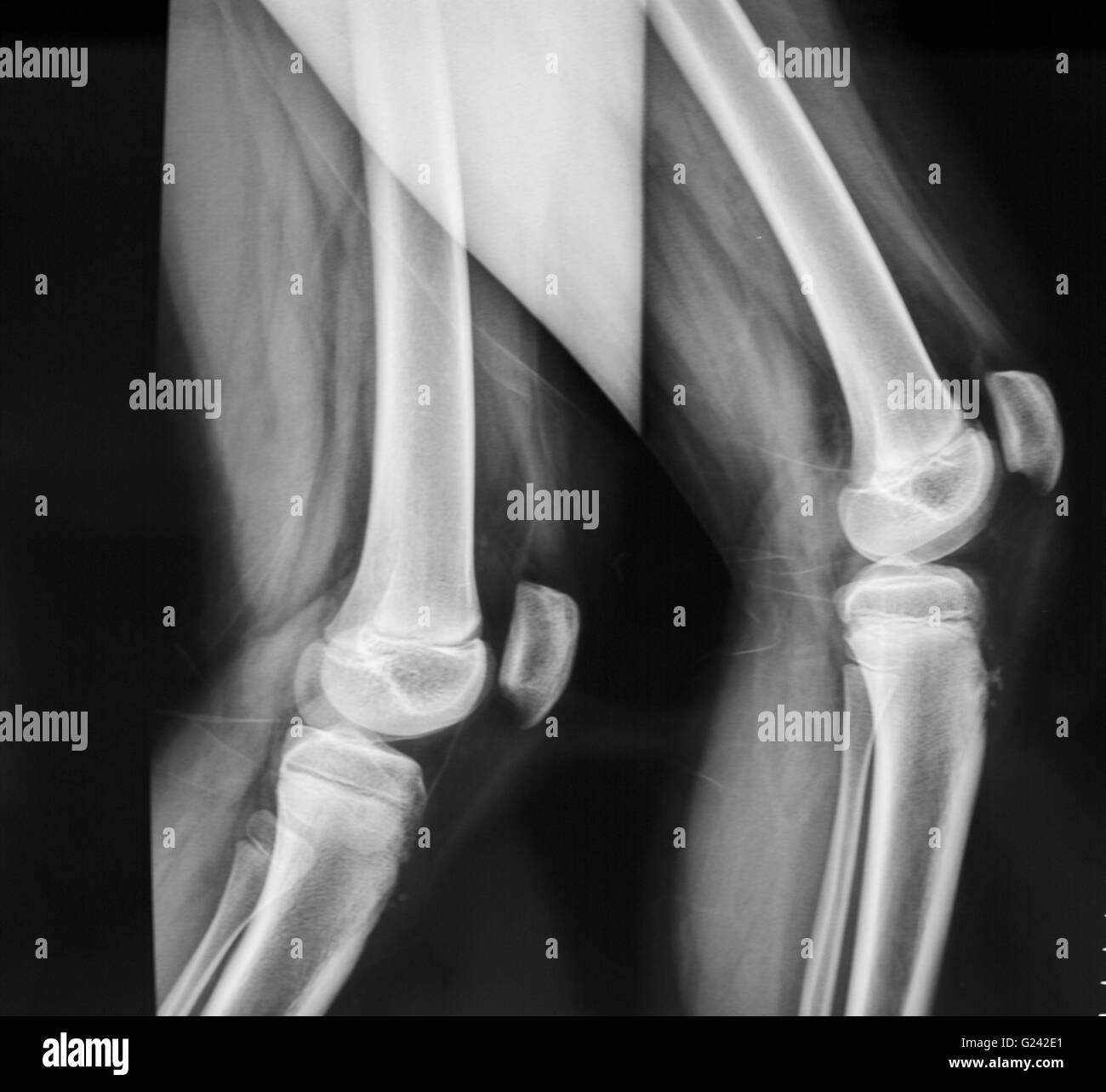 Bone scan knees Black and White Stock Photos & Images Alamy