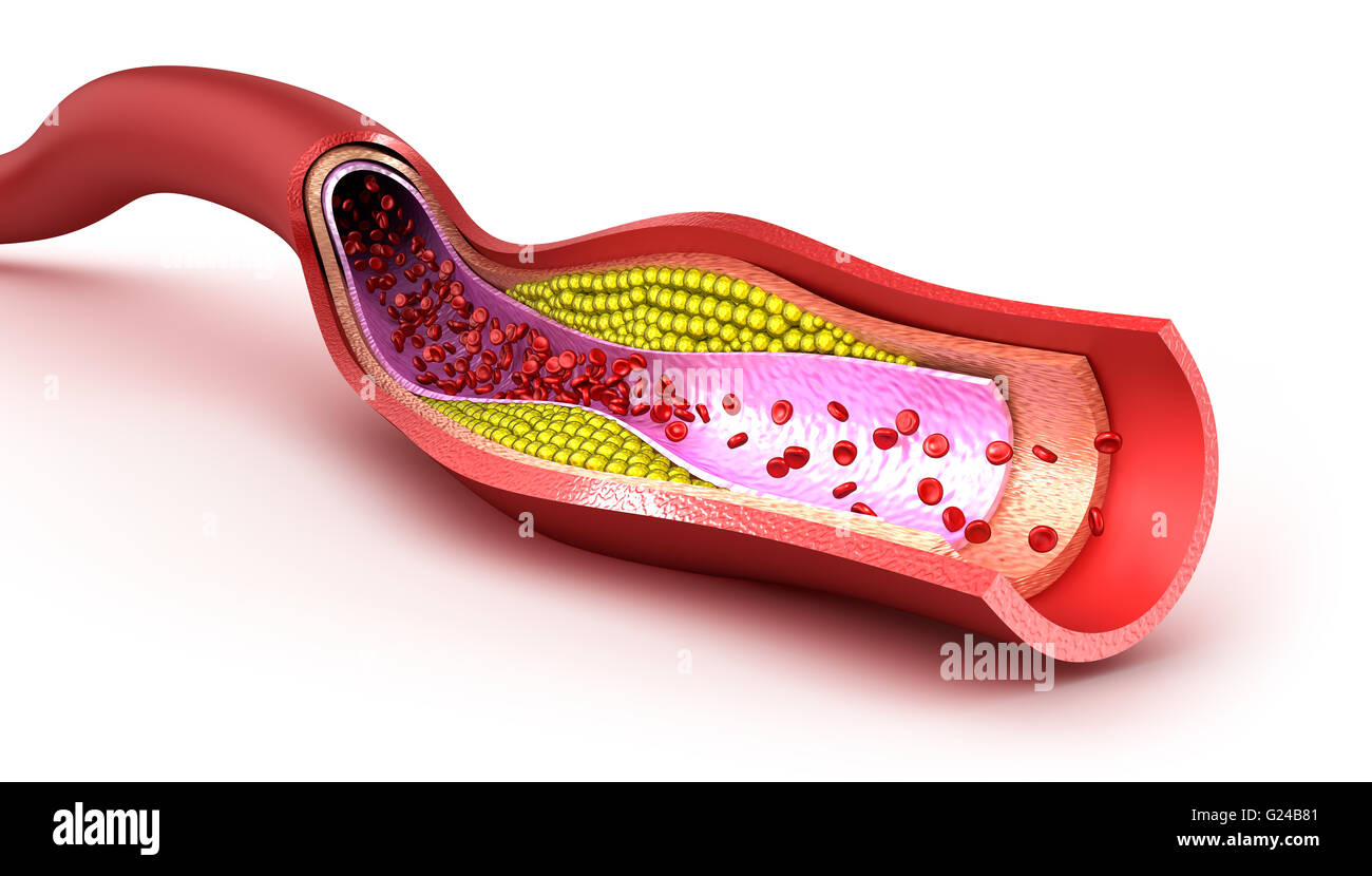 Cholesterol plaque in blood vessel, illustration Stock Photo Alamy