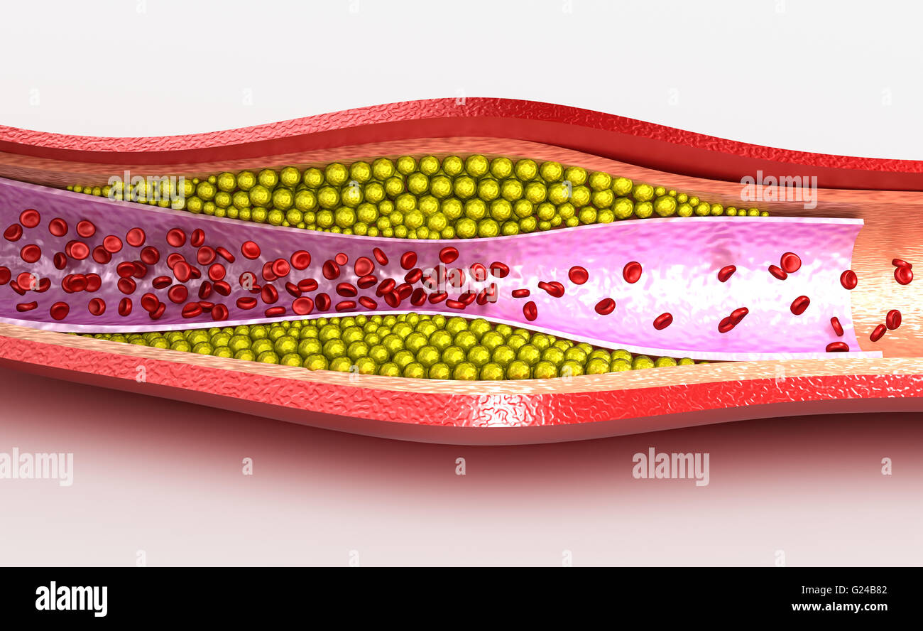 Cholesterol plaque in blood vessel, illustration Stock Photo - Alamy