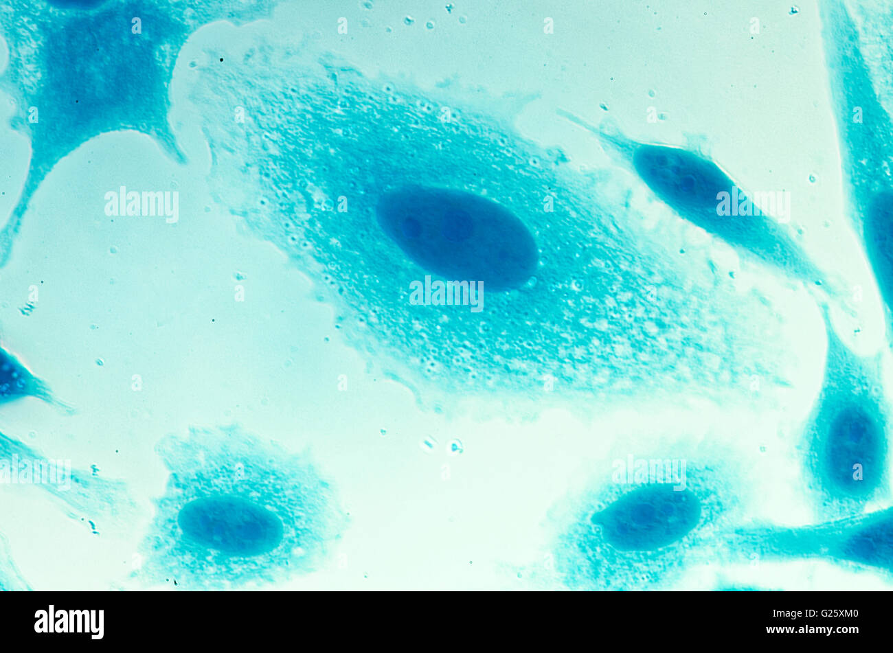 PC-3 human prostate cancer cells, stained with Coomassie blue, under differencial interference contrast microscope. Stock Photo