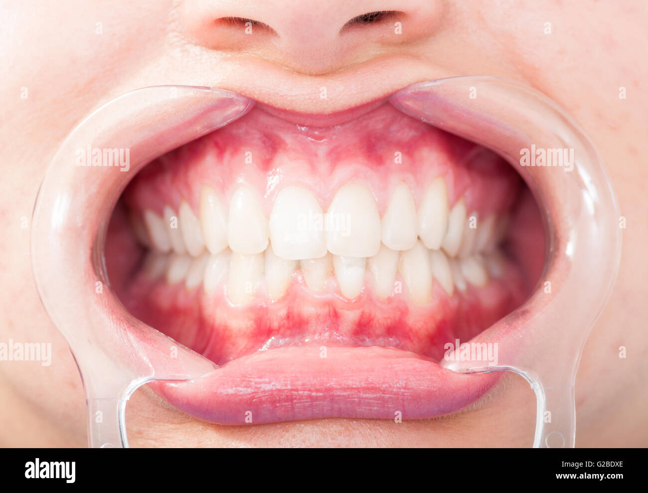Close-up of frontal view of woman white teeth with retractor in dental office Stock Photo
