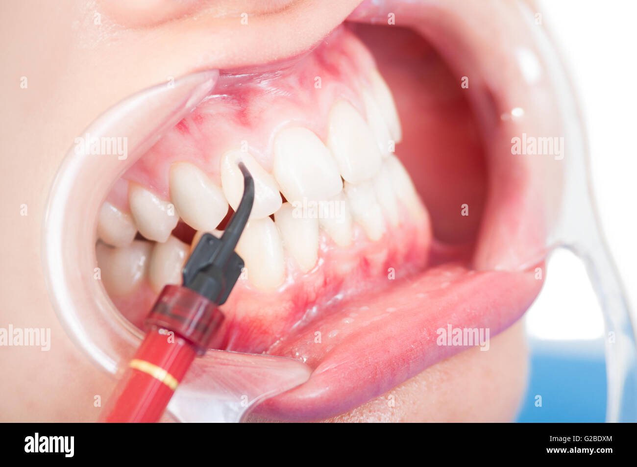 Close up of female mouth with retractor and composite use for whitening the teeth in dental office Stock Photo