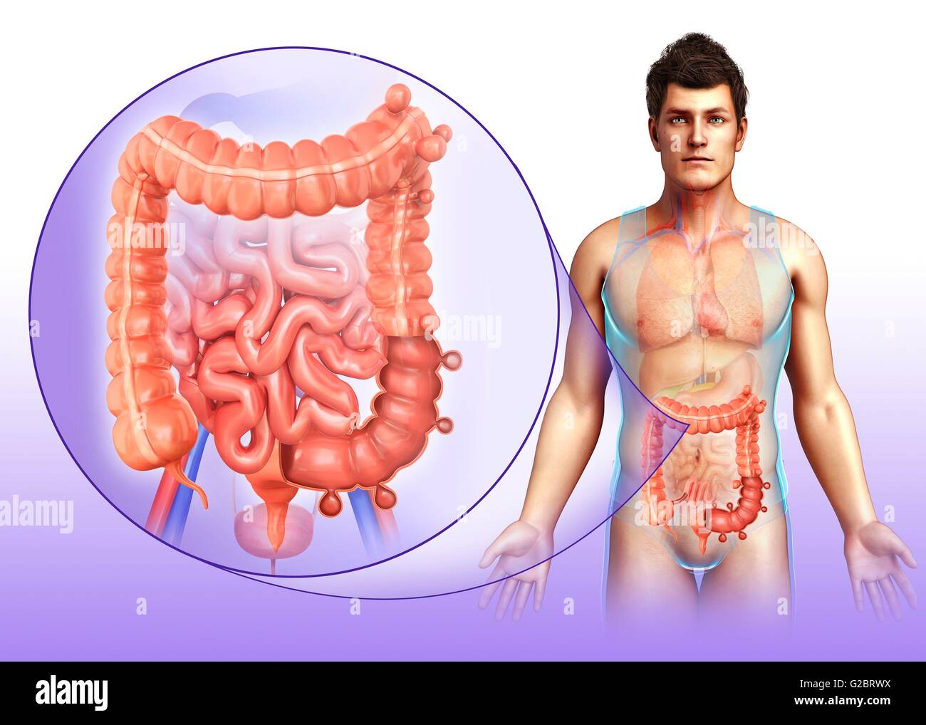 Diverticulosis Of The Human Colon Illustration Stock Photo Alamy