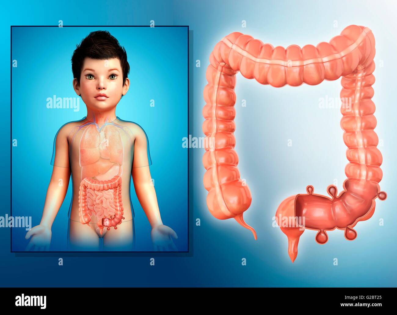 Diverticulosis Of The Large Intestine Of A Child Illustration Stock 