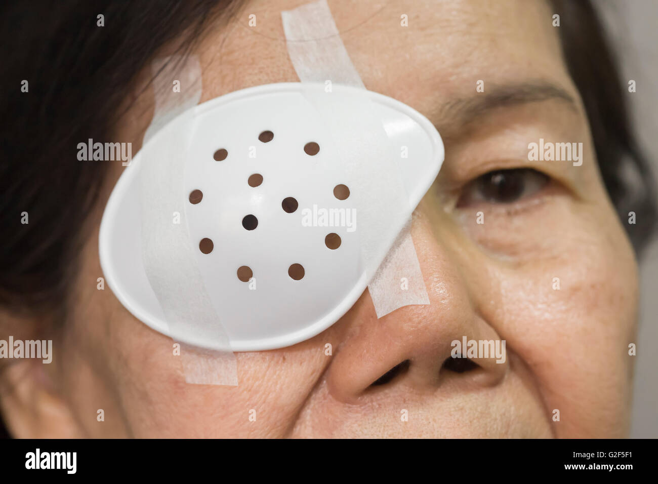 Eye shield covering after cataract surgery. Stock Photo