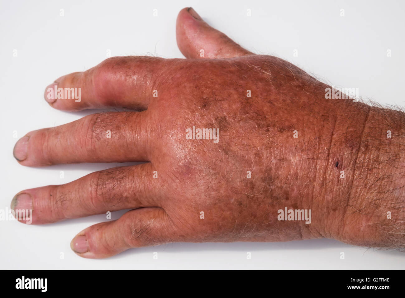 Arthritic hand of an elderly man Stock Photo