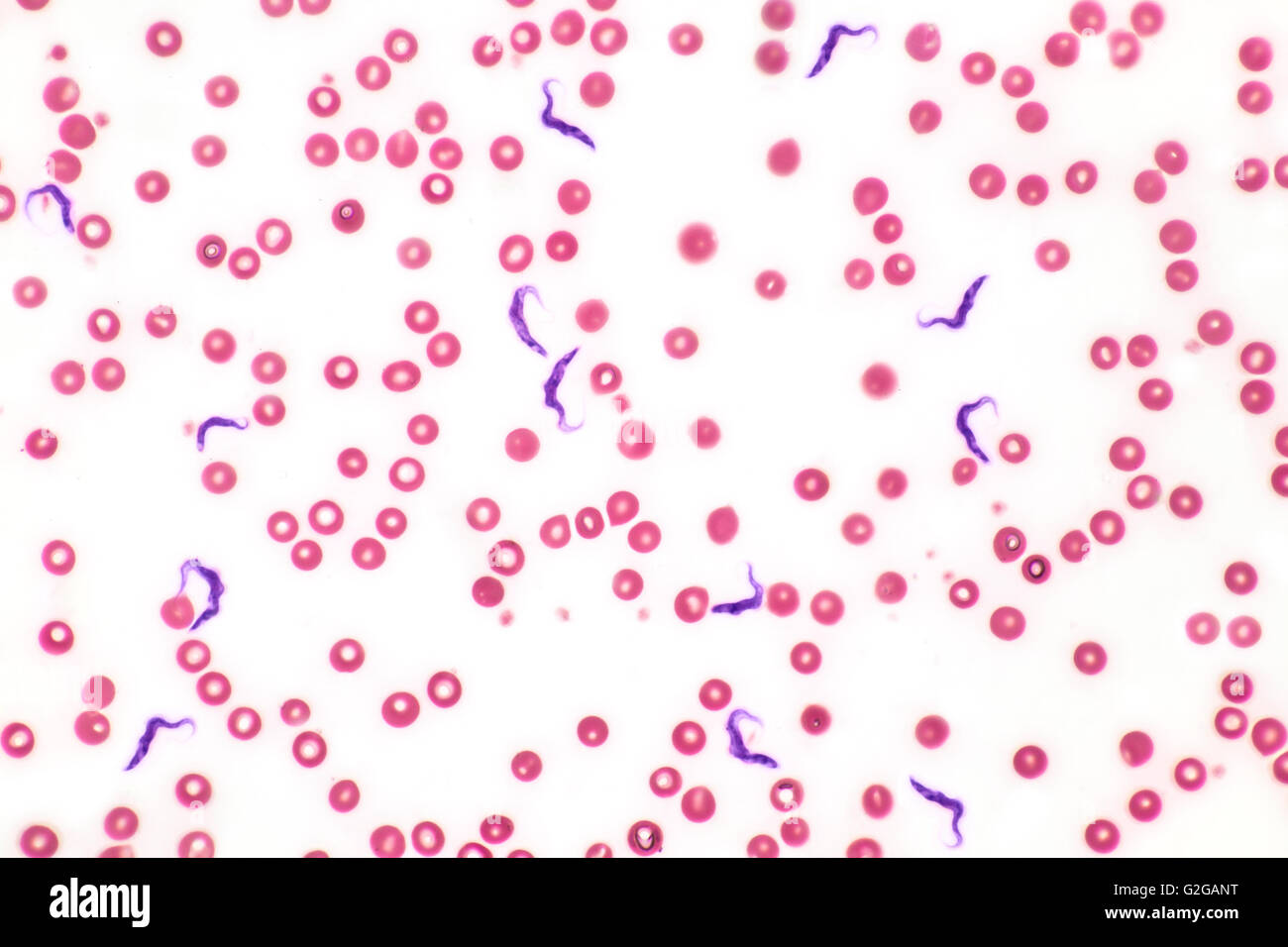 Sleeping sickness, trypanosomiasis parasite trypanosoma forms in human blood, brightfield photomicrograph. Stock Photo