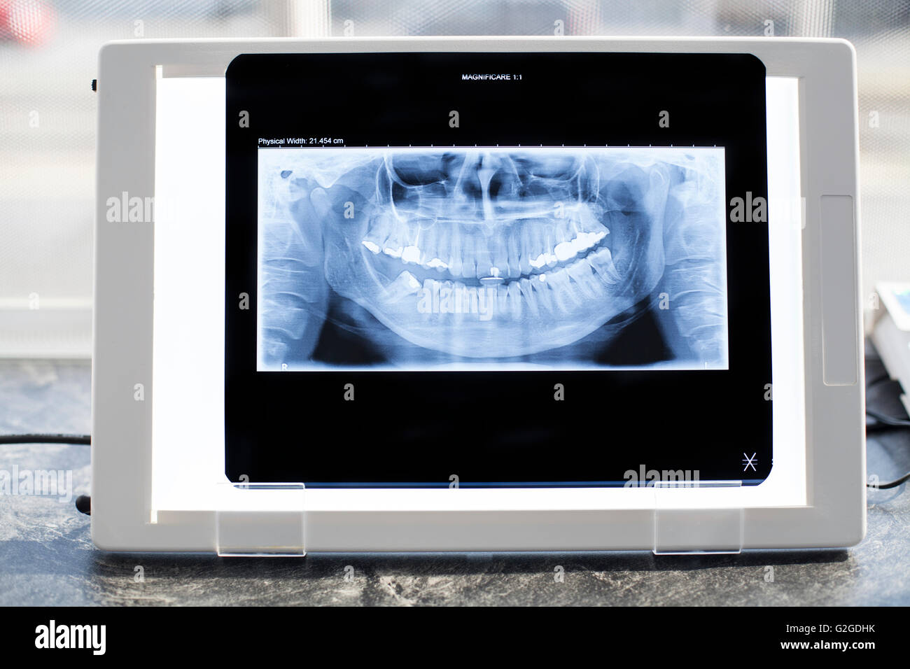 Dental panoramic xray in an xray viewer Stock Photo Alamy