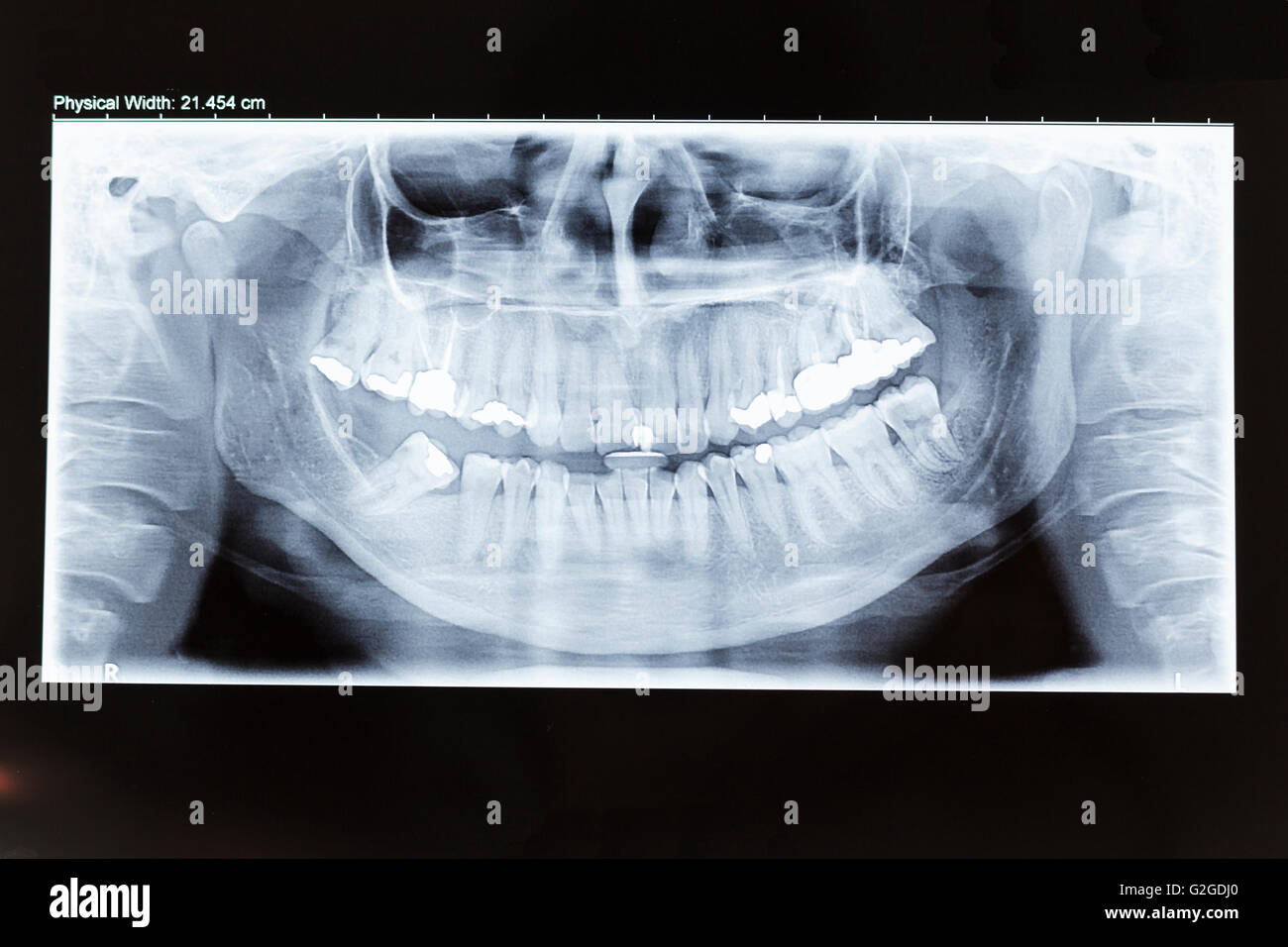 Panoramic x ray hires stock photography and images Alamy