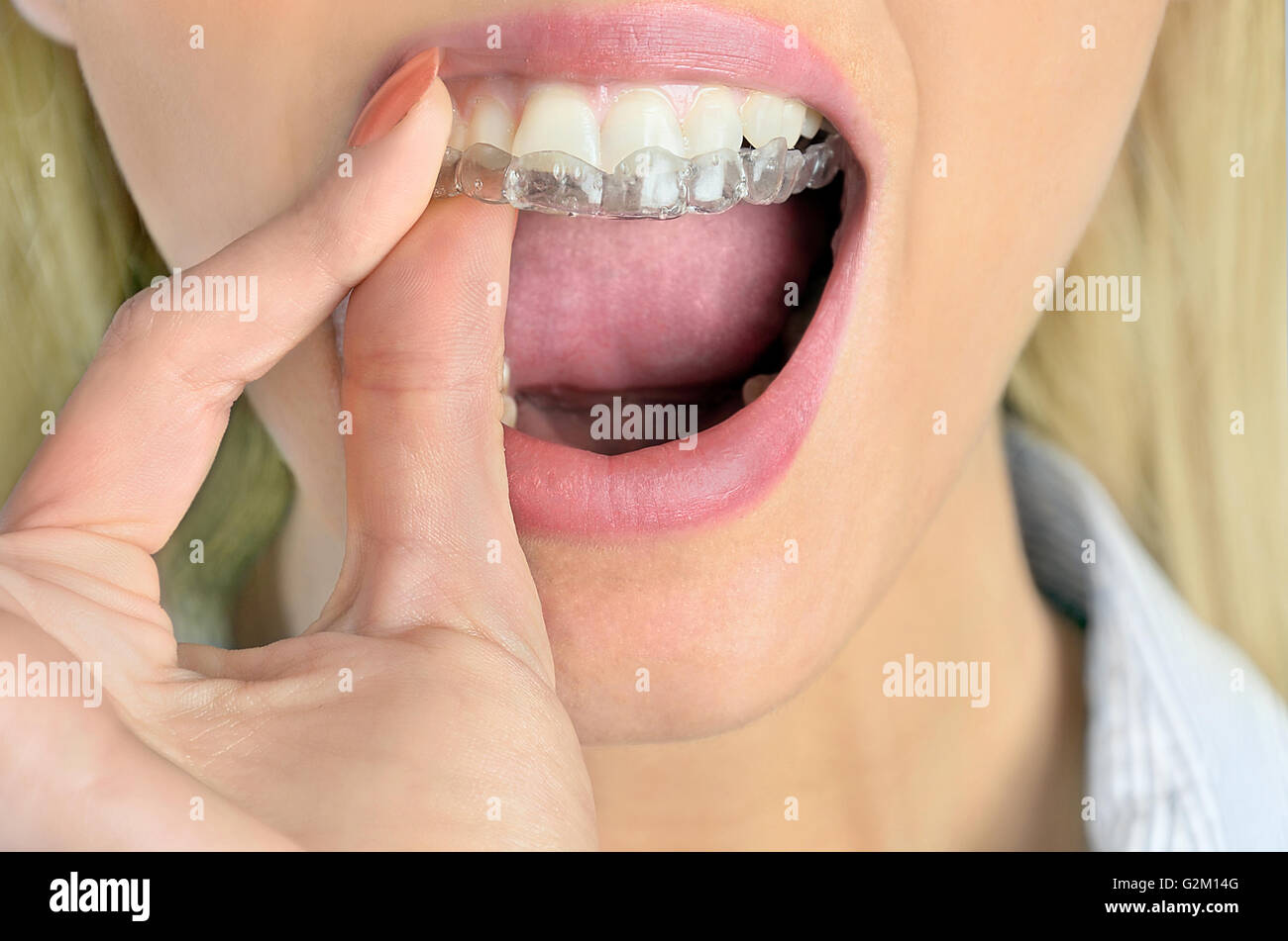 Woman put mouth guard on teeth Stock Photo Alamy