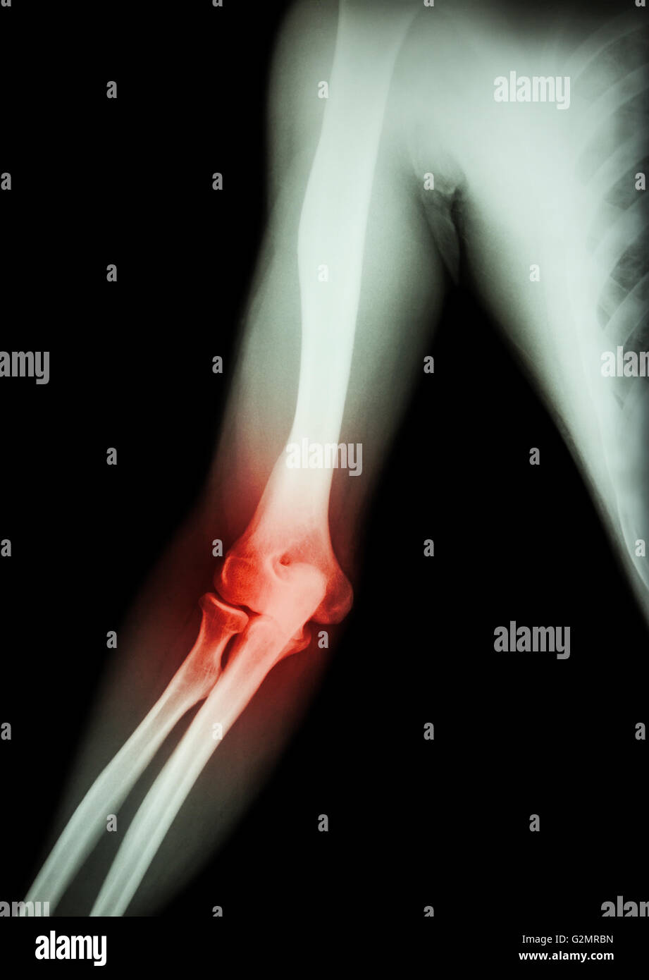 Arthritis at elbow .  film x-ray of arm , elbow , forearm and inflammation at elbow ( Gouty arthritis , Rheumatoid arthritis ) Stock Photo