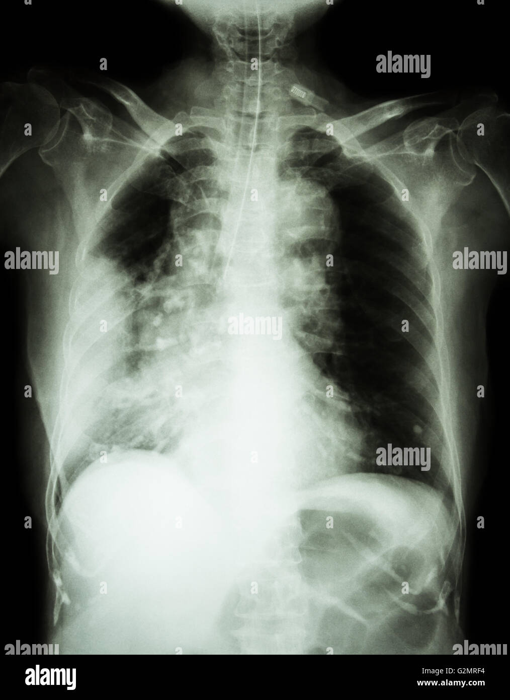 Chest Xray For Diagnosis Of Lung Cancer