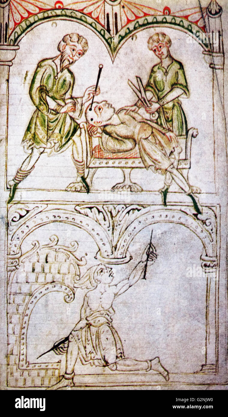 Mediaeval drawing demonstrating the cautery of the temples; the lower part of the drawing depicts the assistant heating the instruments. Dated 12th Century Stock Photo