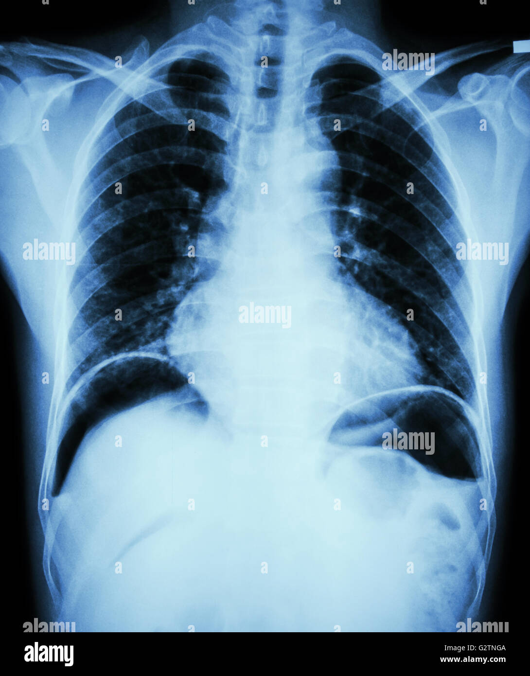 Peptic ulcer perforate . ( film chest x-ray show free air under dome of both diaphragm due to air leak from gastric ulcer or duo Stock Photo