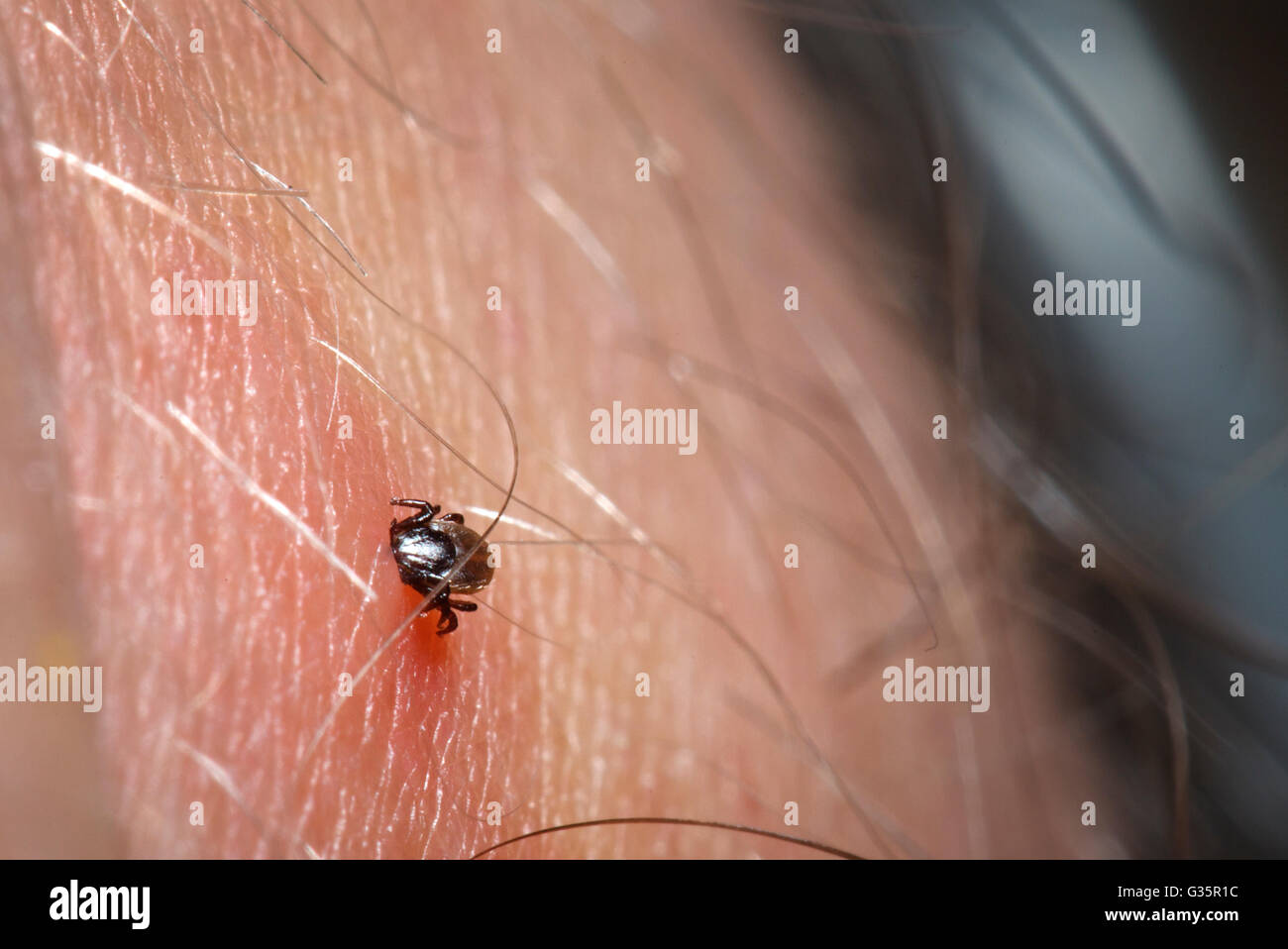 A tick embedded into a human Stock Photo