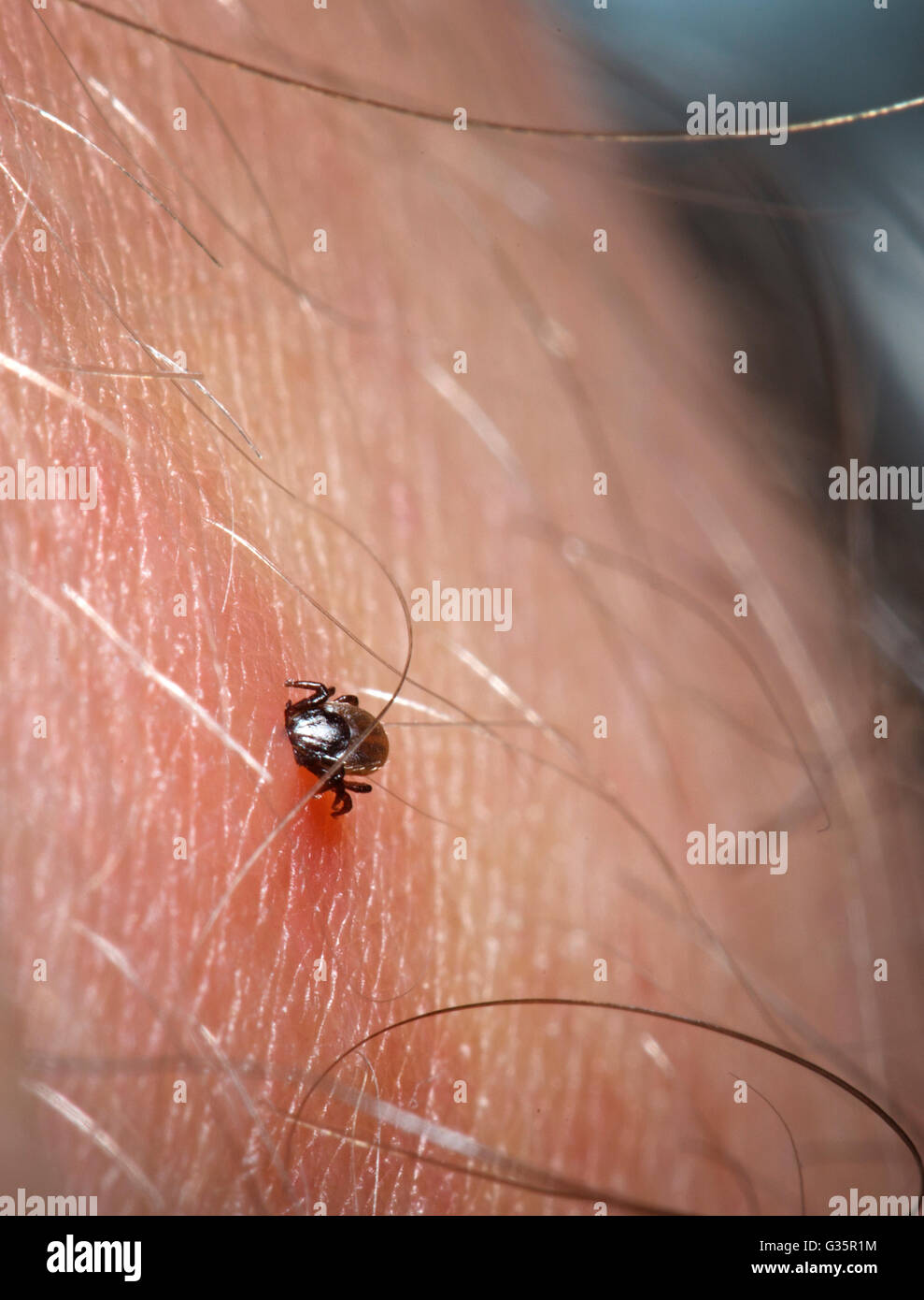 A tick embedded into a human Stock Photo