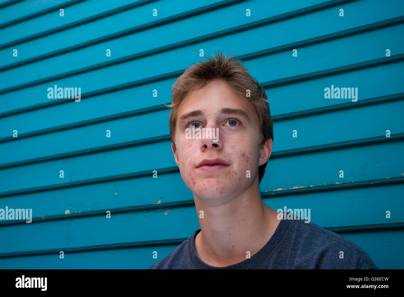 teenage boy with acne Stock Photo