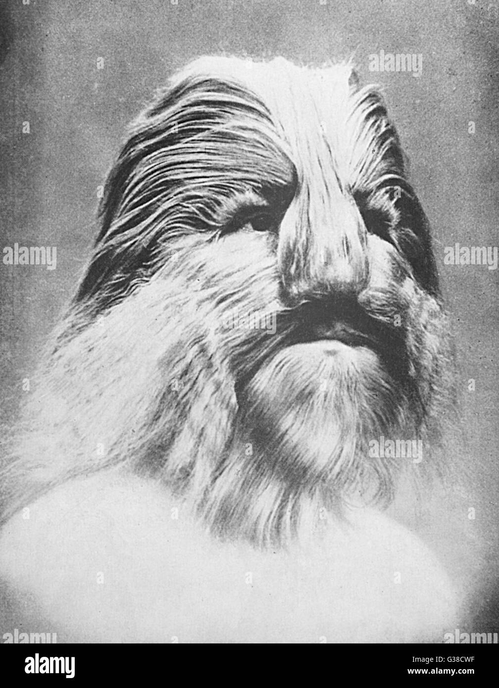 Stephan Bibrowski (18911932), better known as Lionel the Lion-faced Man, was a famous sideshow performer. His whole body was covered with long hair that gave him the appearance of a lion; this was likely due to a rare condition called hypertrichosis. Stock Photo