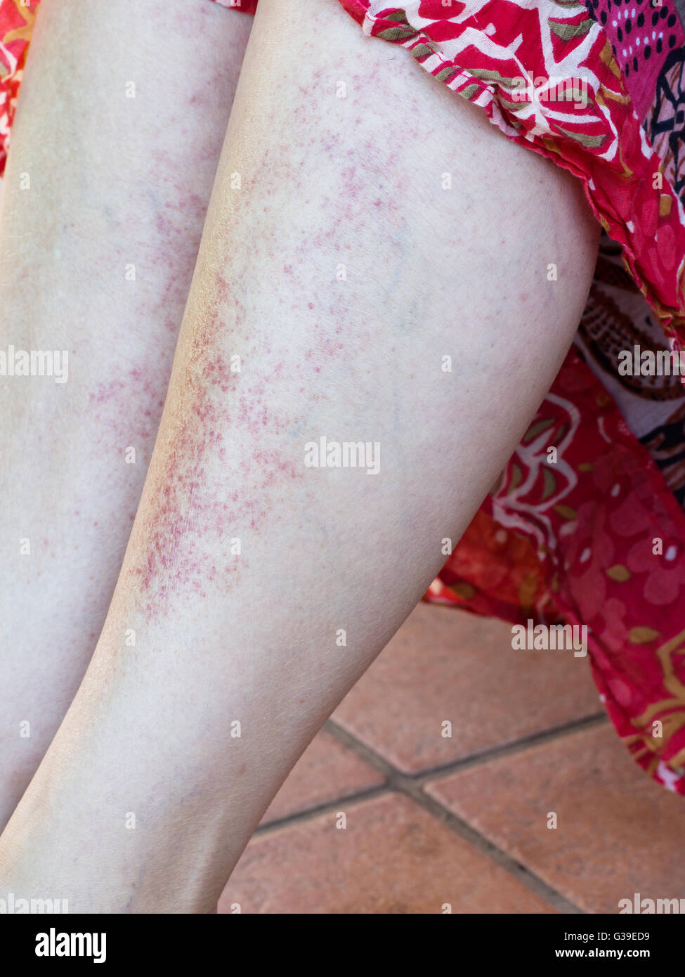 Red rash from combining sunbathing and medication. Allergy, sensitivity. Stock Photo