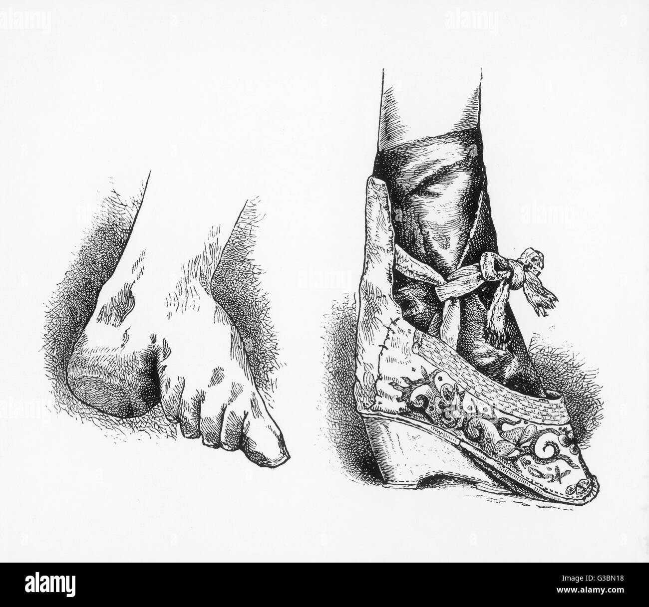 The damage caused by the practise of Chinese foot binding to the