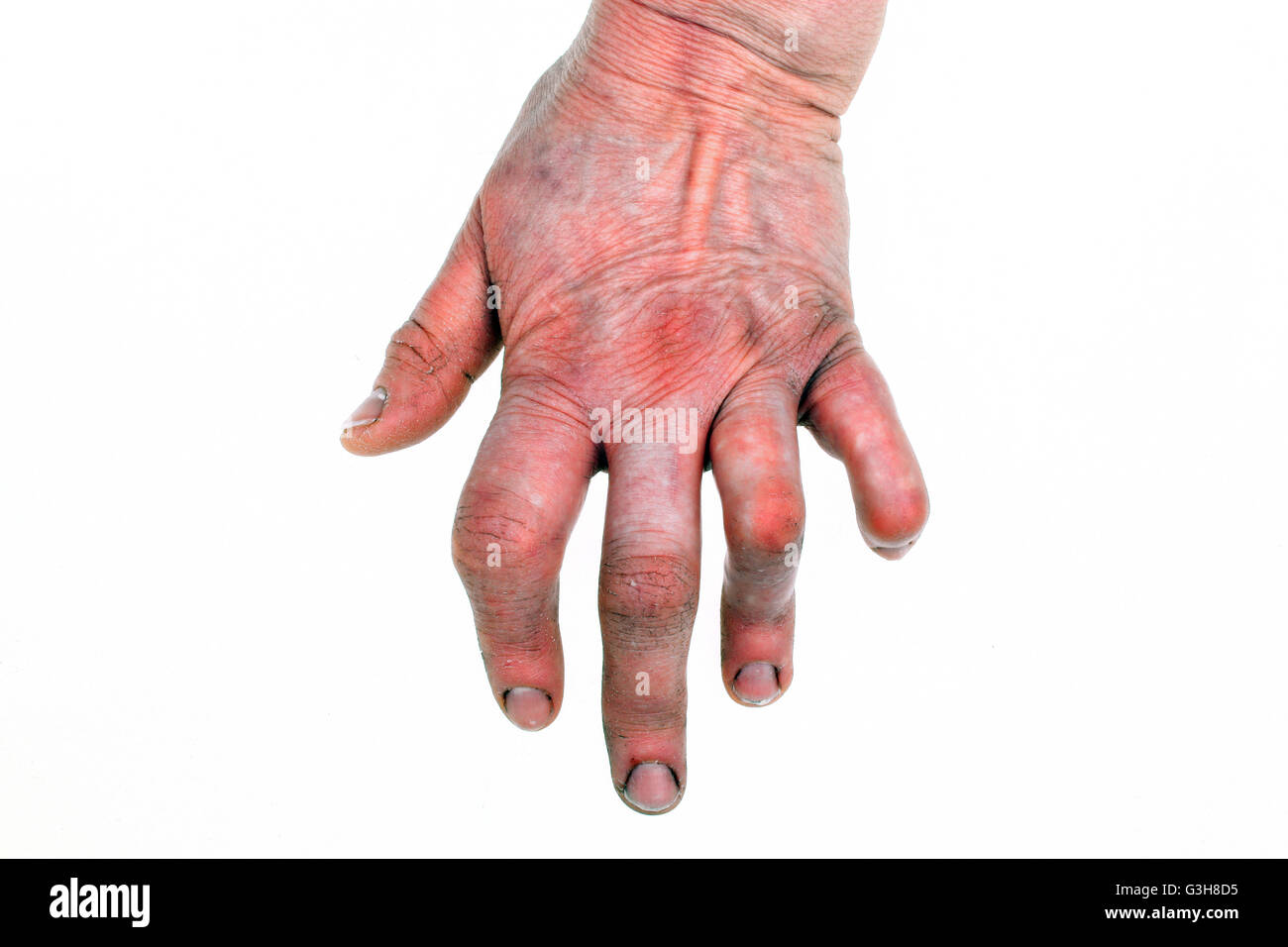 Woman's hand deformed from rheumatoid arthritis Stock Photo Alamy