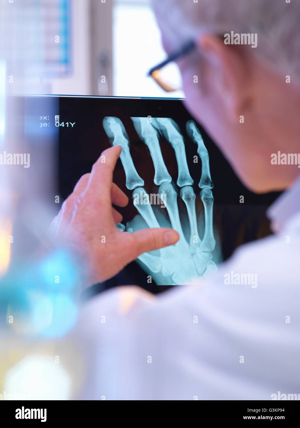 Radiographer looking at x-ray of hand fracture Stock Photo