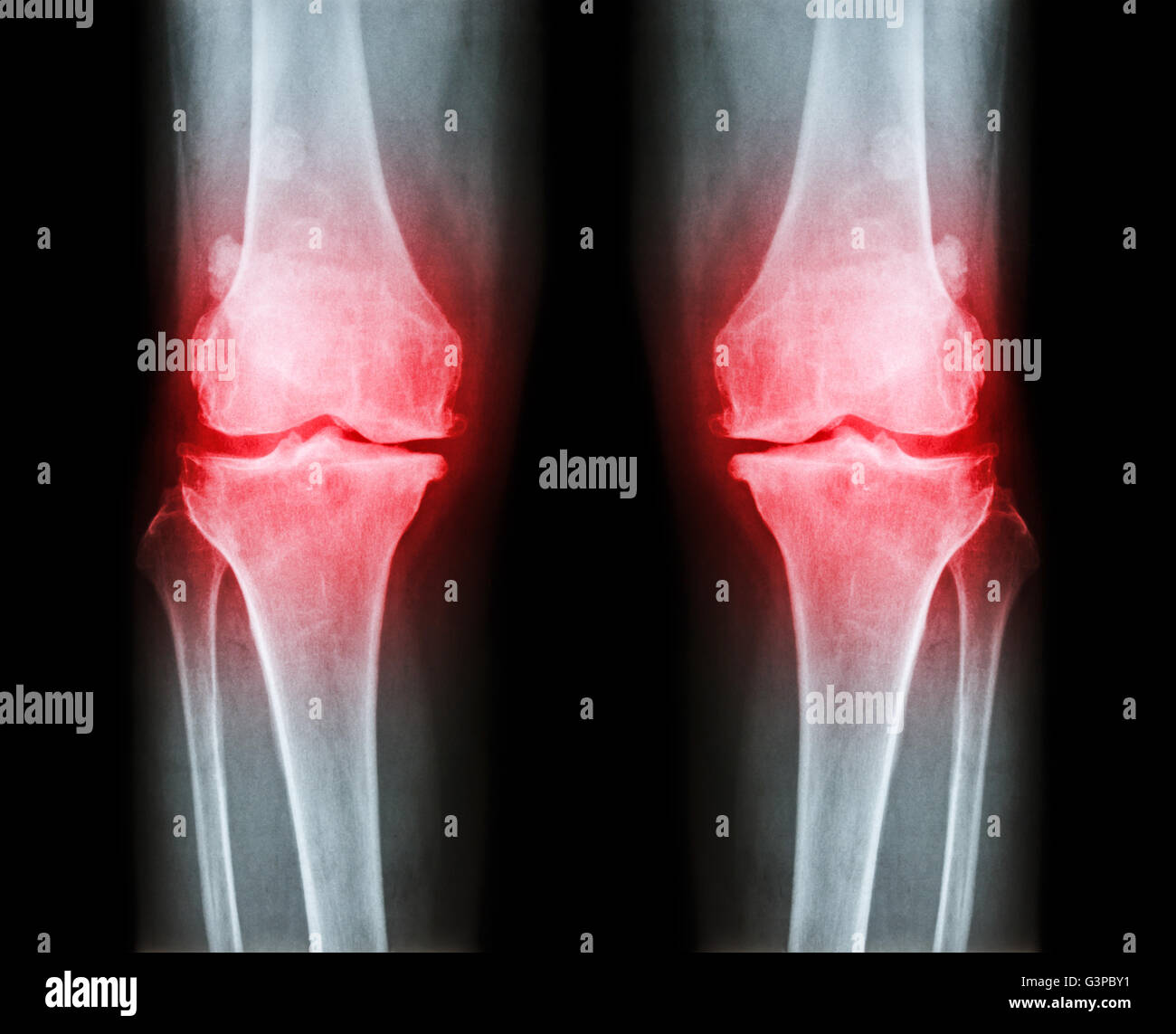 Osteoarthritis both knee . film xray AP ( anterior posterior ) of