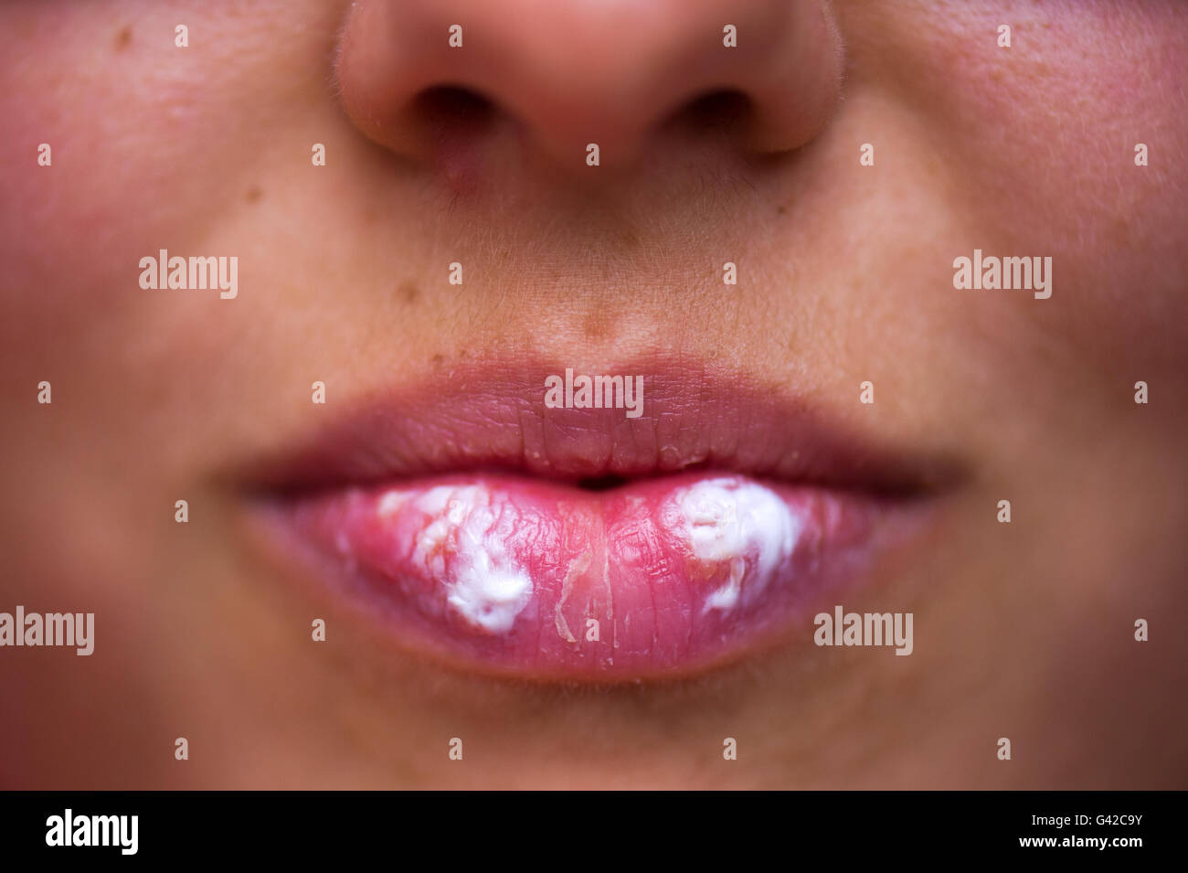 Dresden, Germany. 15th June, 2016. ILLUSTRATION - A woman with lip herpes (Herpes labialis) has put an ointment on the infected places. In the vernacular, symptoms of an infection with the herpes-simplex-virus type I are called 'fever blisters'. Photo: Arno Burgi/dpa/Alamy Live News Stock Photo