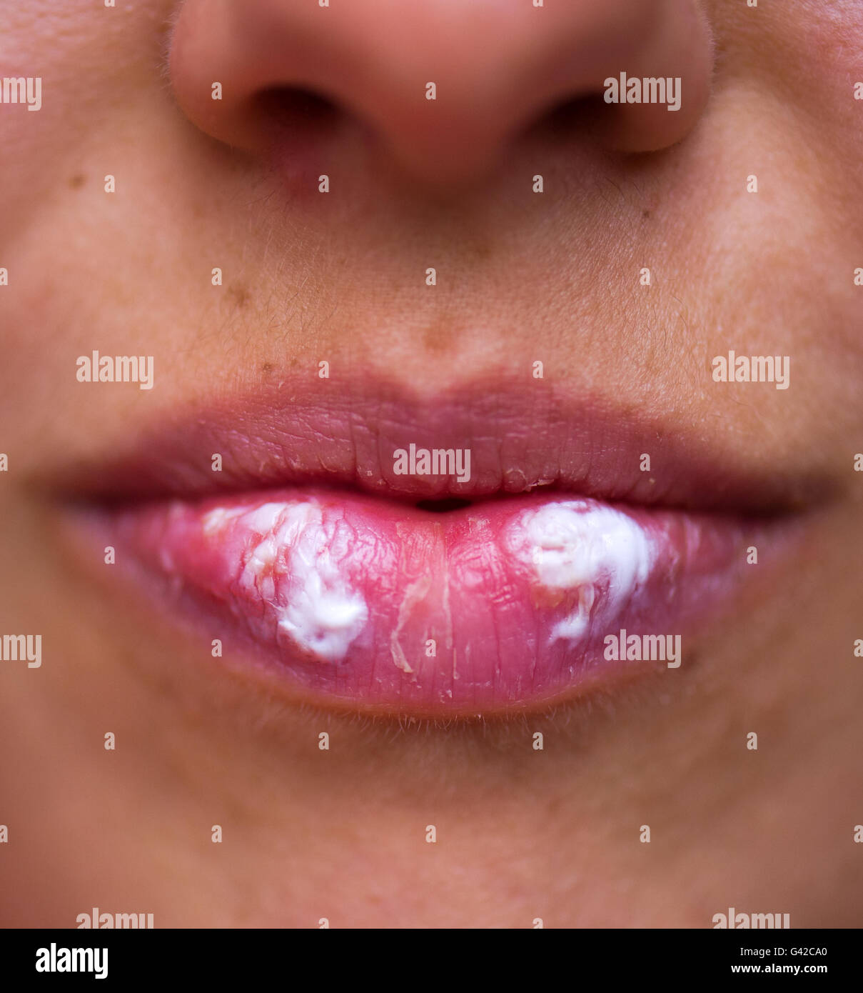 Dresden, Germany. 15th June, 2016. ILLUSTRATION - A woman with lip herpes (Herpes labialis) has put an ointment on the infected places. In the vernacular, symptoms of an infection with the herpes-simplex-virus type I are called 'fever blisters'. Photo: Arno Burgi/dpa/Alamy Live News Stock Photo