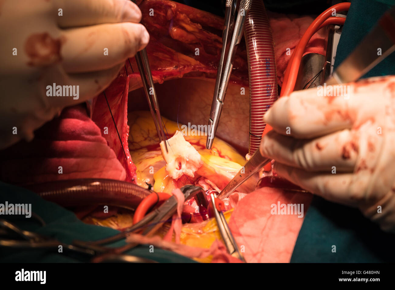 bentall's operation in ascending aortic aneurysm Stock Photo