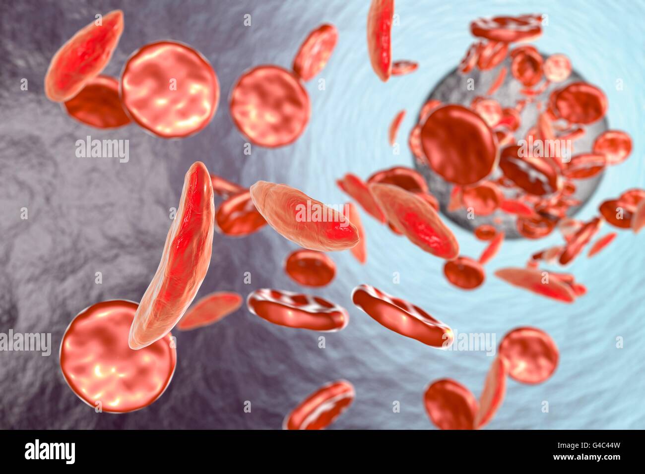 Sickle cell anaemia. Artwork showing normal red blood cells (round), and red blood cells affected by sickle cell anaemia (crescent shaped). This is a disease in which the red blood cells contain an abnormal form of haemoglobin (blood's oxygen-carrying pigment) that causes the blood cells to become sickle-shaped, rather than round. Sickle cells cannot move through small blood vessels as easily as normal cells and so can cause blockages (right). This prevents oxygen from reaching the tissues, causing severe pain and organ damage. Stock Photo