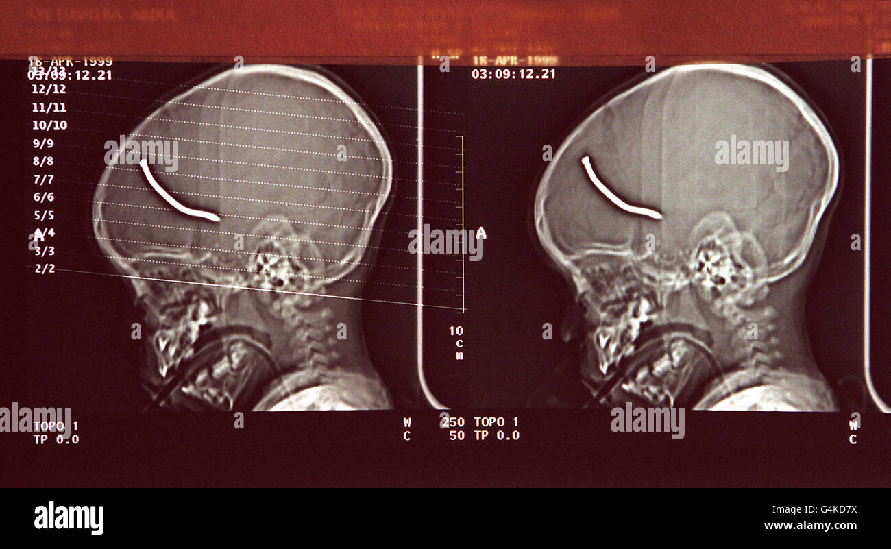 A picture issued by Great Ormond Street Children's Hospital showing a CAT scan of the head of a 23 month-old toddler who was injured in the nail bomb explosion in Brixton, South London. It shows a 4 inch nail embedded in his brain after it went through his left temple. * Doctors at the hospital say that the youngster should make a full recovery and will have only a faint scar on his left temple to show for his ordeal. Stock Photo