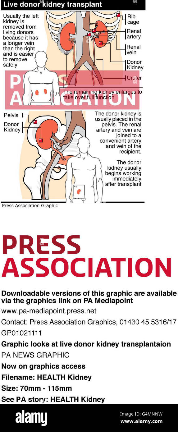 HEALTH Kidney. Graphic looks at live donor kidney transplantation Stock Photo