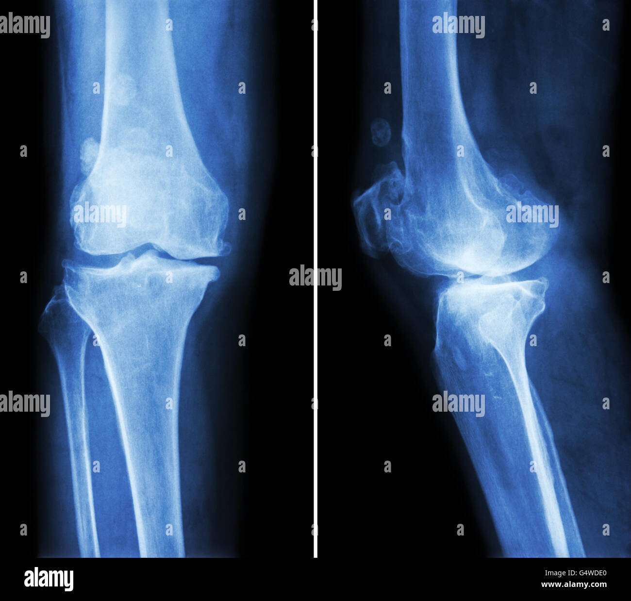 Osteoarthritis knee .  film x-ray knee ( anterior - posterior and lateral view )  show narrow joint space , osteophyte ( spur ) Stock Photo