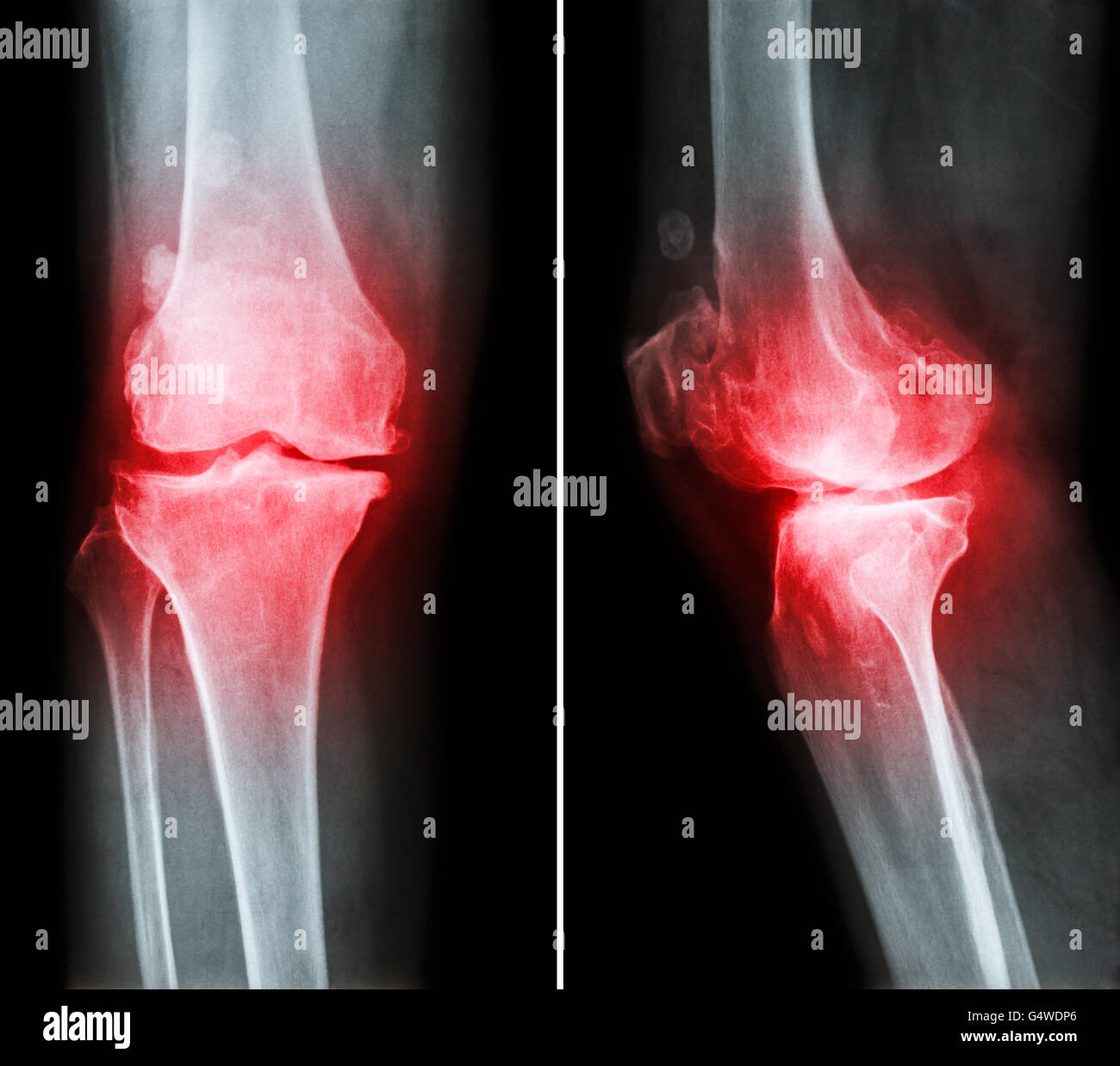Osteoarthritis knee .  film x-ray knee ( anterior - posterior and lateral view )  show narrow joint space , osteophyte ( spur ) Stock Photo