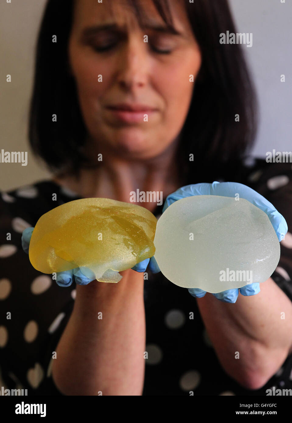 Scottish PiP implant victim Jenny Brown, from Edinburgh poses with her ruptured PiP implants after having them recently removed. PRESS ASSOCIATION Photo. Picture date: Wednesday February 15, 2012. During a press conference in Glasgow she spoke of her recent operation to remove her ruptured PiP implants and urged other people caught up in the affair to come forward. Photo credit should read: Andrew Milligan/PA Wire Stock Photo