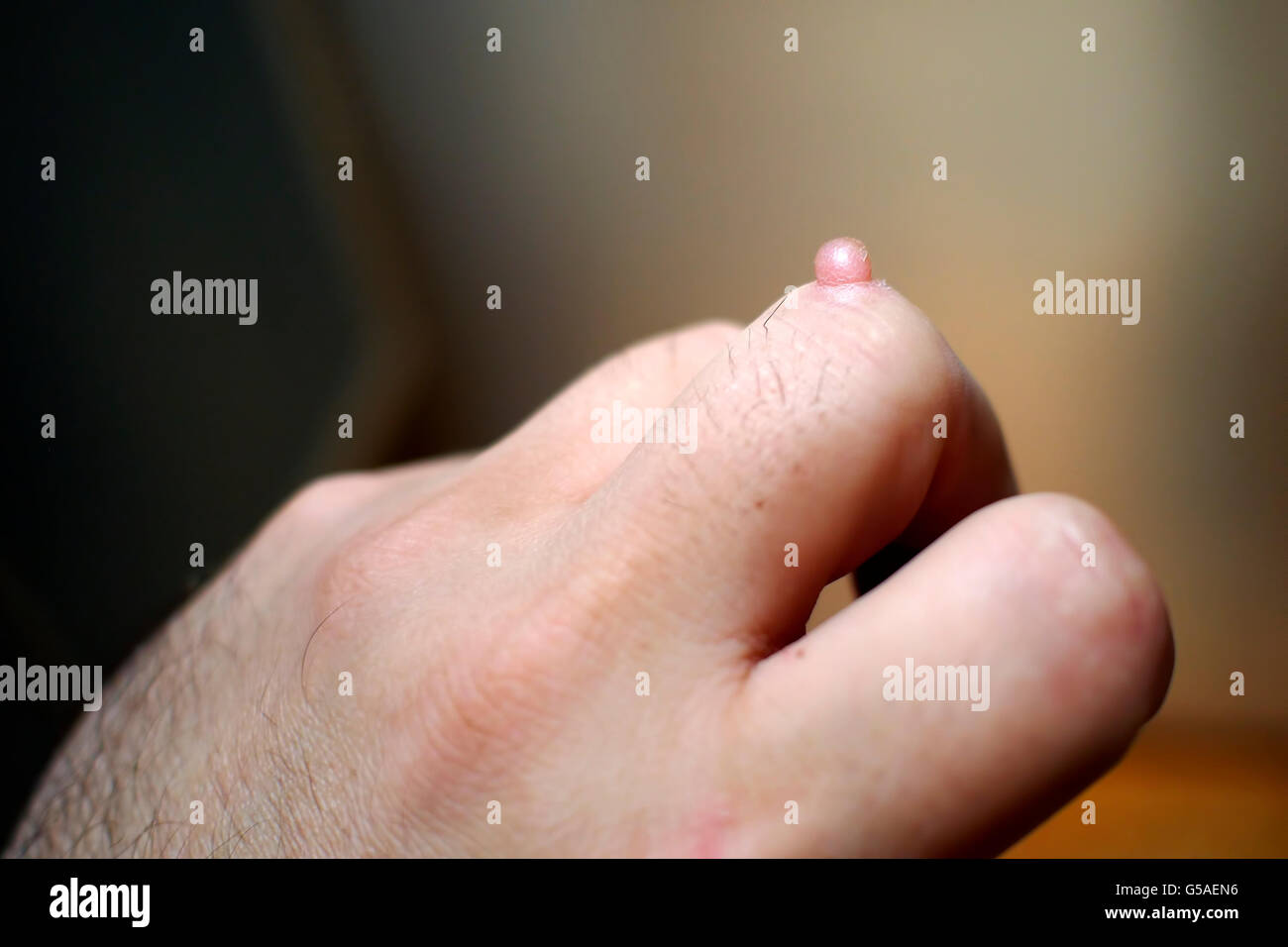 Wart on the hand finger. Stock Photo