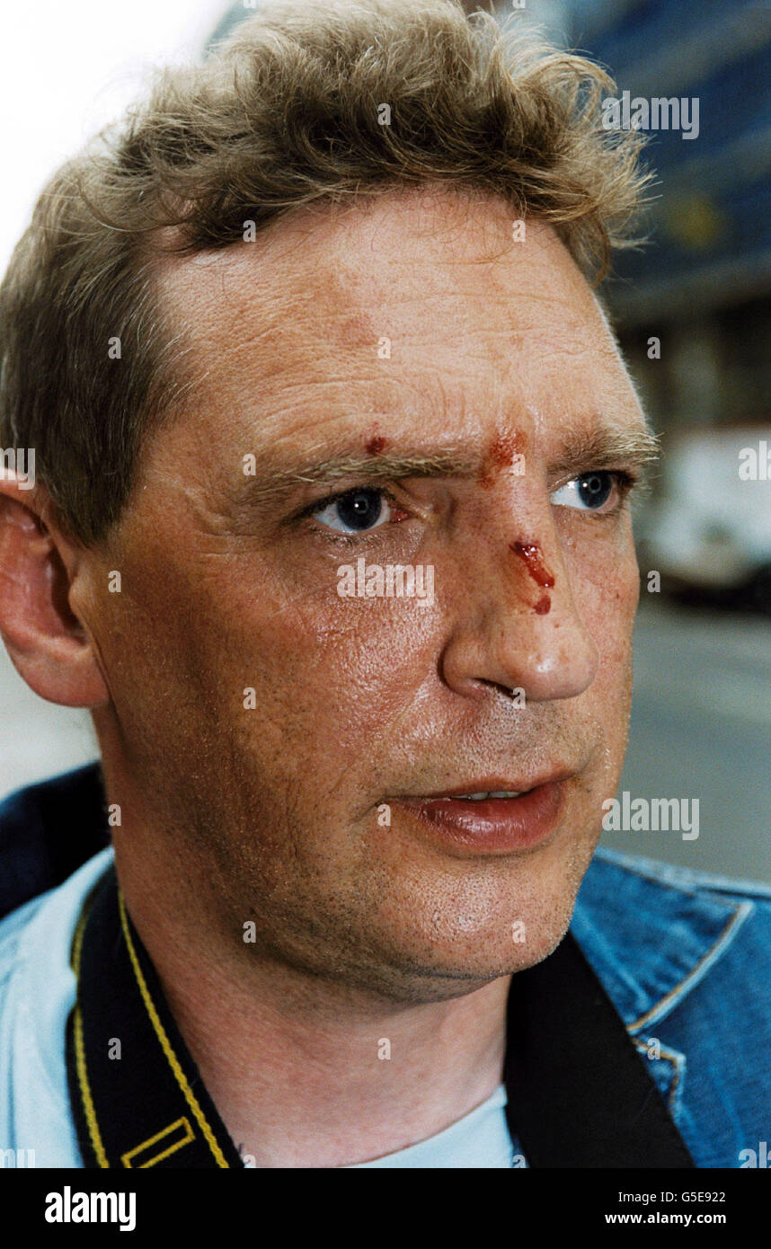 Paparazzi photorapher John Lillington after he was hit in the face by Oasis singer Liam Gallagher outside the Portland hospital, West London. Gallagher was visiting his girlfriend Nicole Appleton after giving birth to their first child. Stock Photo