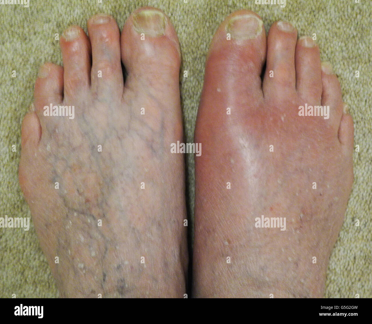 Gout Foot High Resolution Stock Photography And Images Alamy