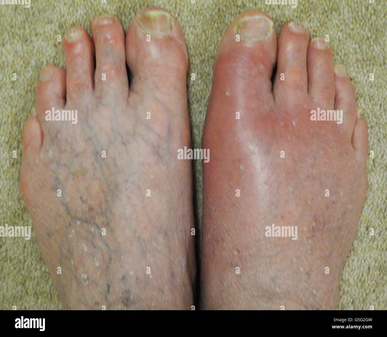 Gout is a type of arthritis where swelling and severe pain develops in joints, especially at the base of the big toe. No model release needed - photographer's own foot ! Stock Photo