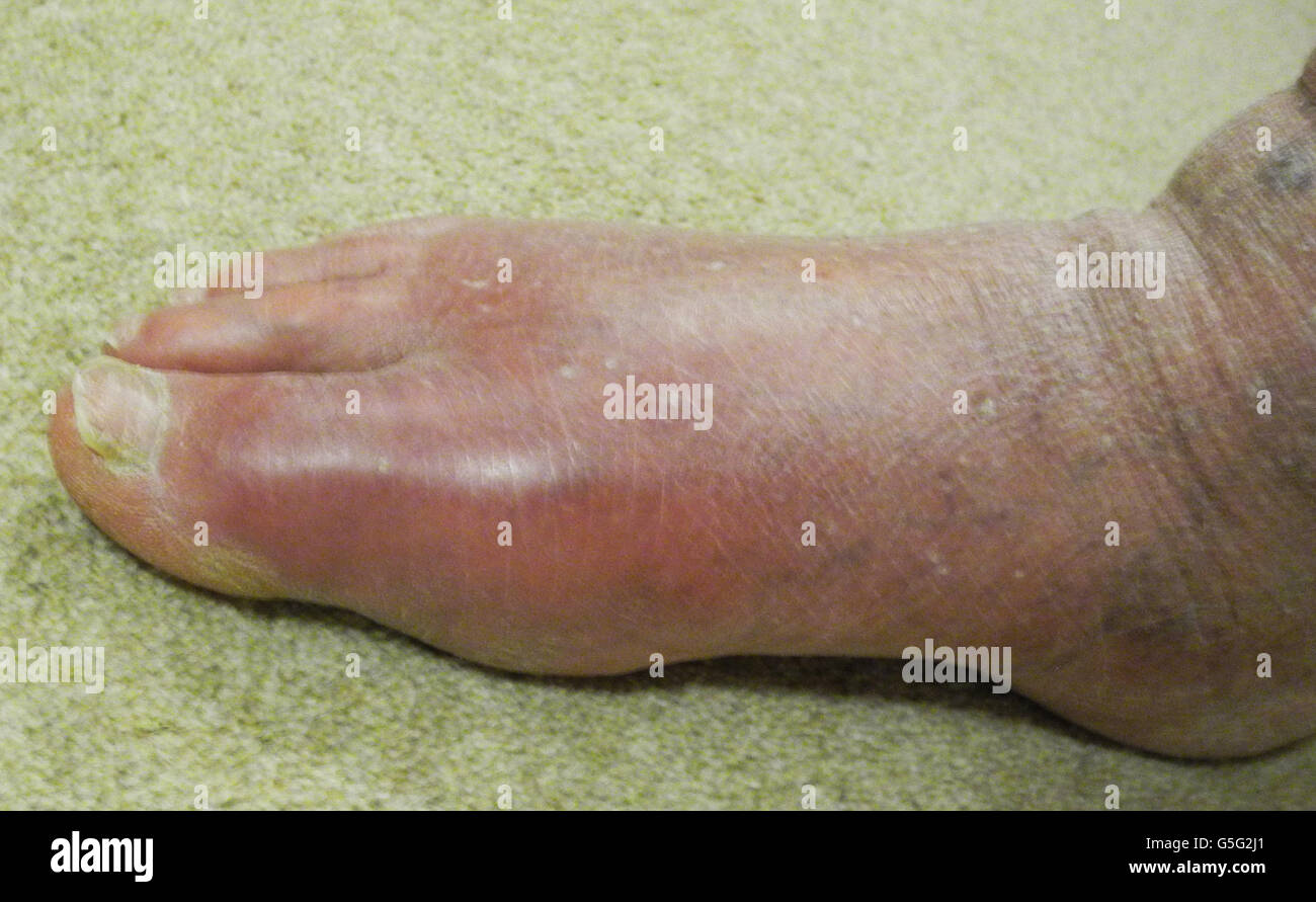 Gout is a type of arthritis where swelling and severe pain develops in joints, especially at the base of the big toe. No model release needed - photographer's own foot ! Stock Photo