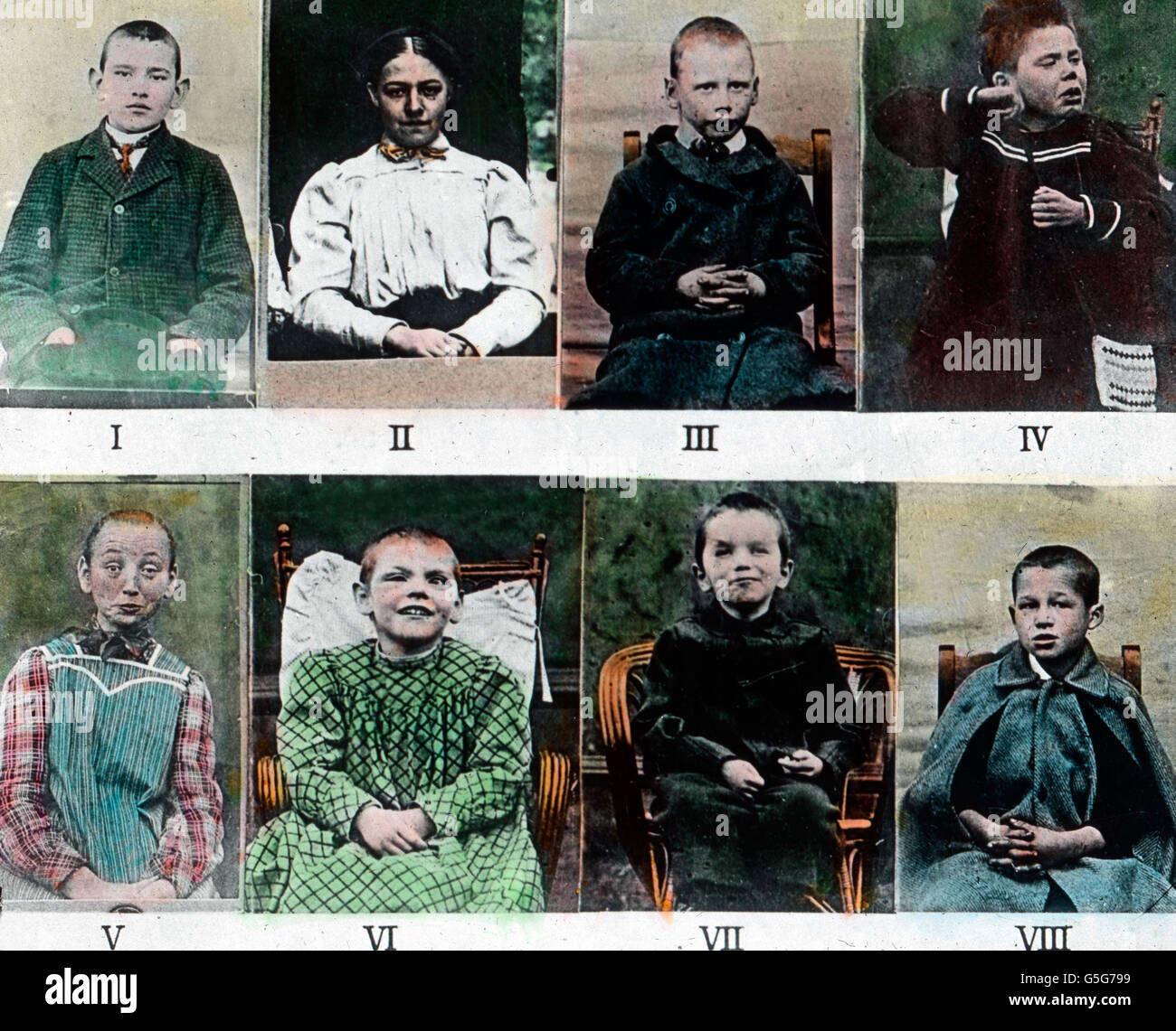 Trinkerkinder. Mentally disabled children as a result of alcoholism. children, handicapped, handicap, retarded, portraits, alcohol, drug, history, historical, 1910s, 1920s, 20th century, archive, Carl Simon, hand coloured glass slide Stock Photo