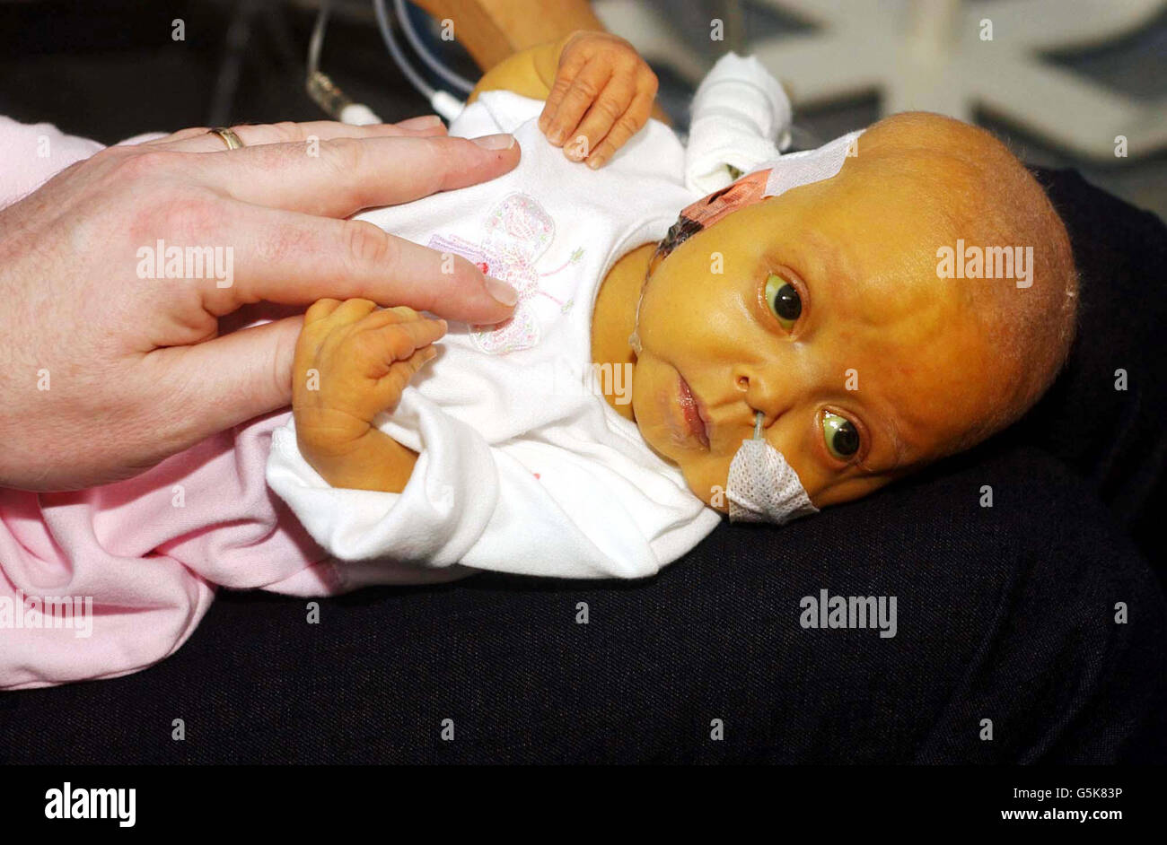 Acute Liver Failure Stock Photos & Acute Liver Failure Stock Images Alamy